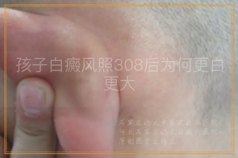 孩子白癜风照308后为何更白更大