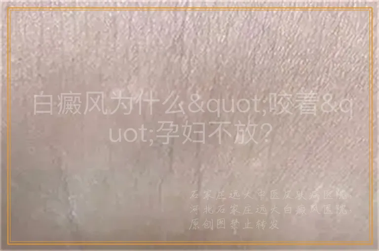 白癜风为什么"咬着"孕妇不放?