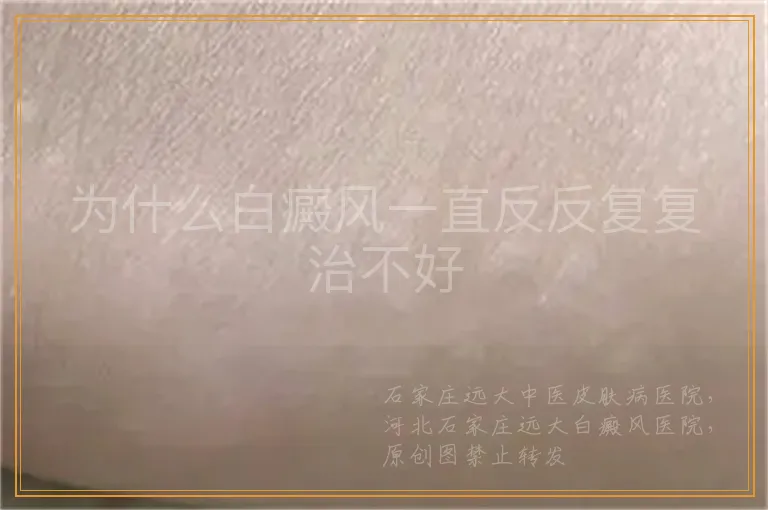 为什么白癜风一直反反复复治不好