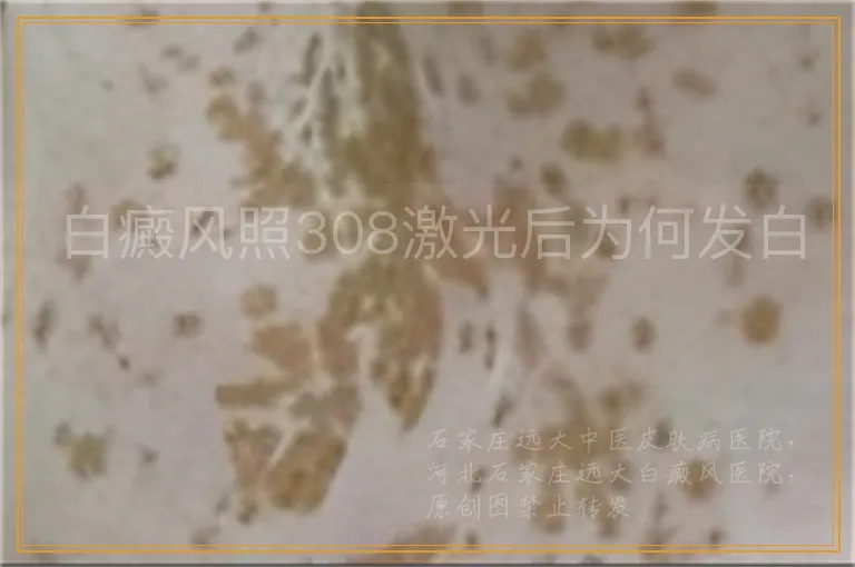 白癜风照308激光后为何发白