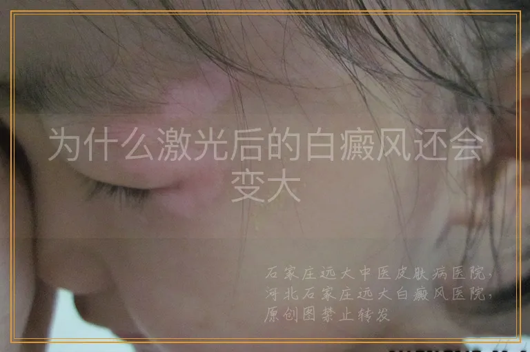 为什么激光后的白癜风还会变大