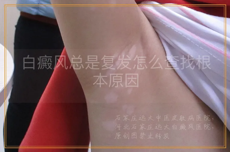 白癜风总是复发怎么查找根本原因