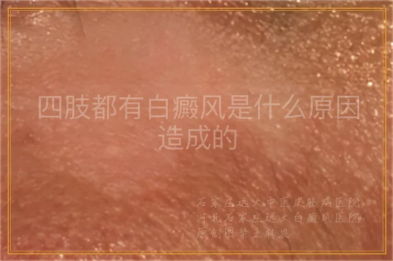 四肢都有白癜风是什么原因造成的