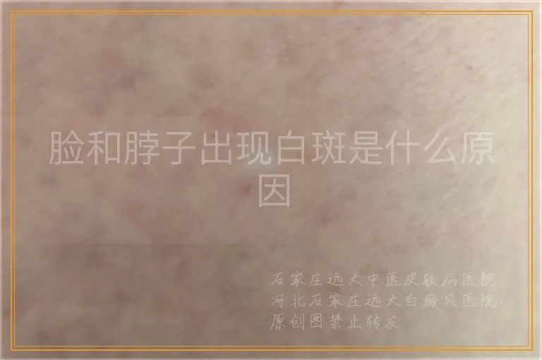 脸和脖子出现白斑是什么原因