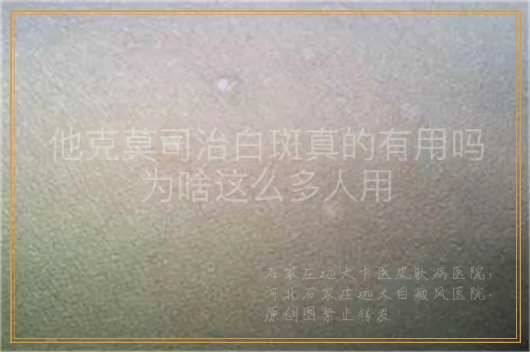 他克莫司治白斑真的有用吗为啥这么多人用