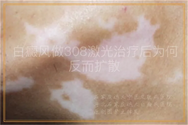 白癜风做308激光治疗后为何反而扩散