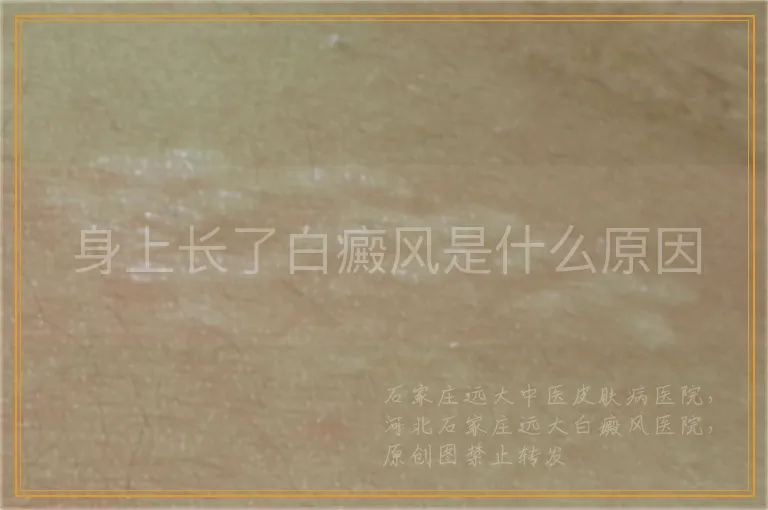 身上长了白癜风是什么原因