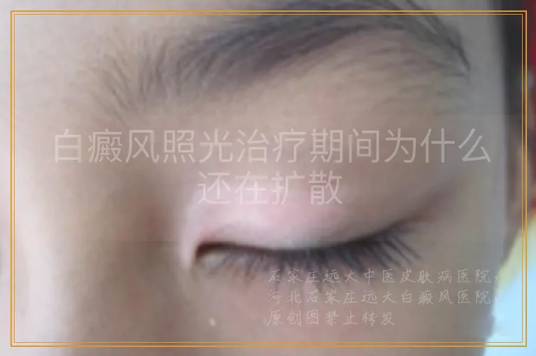 白癜风照光治疗期间为什么还在扩散
