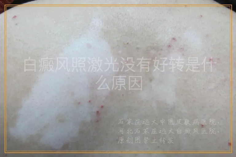 白癜风照激光没有好转是什么原因