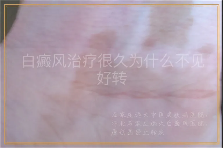 白癜风治疗很久为什么不见好转