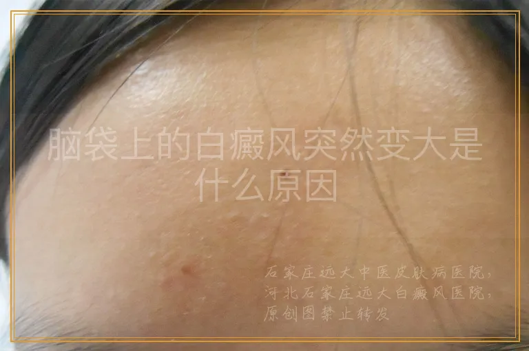 脑袋上的白癜风突然变大是什么原因