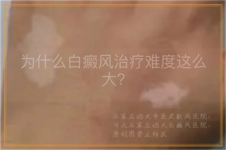 为什么白癜风治疗难度这么大？