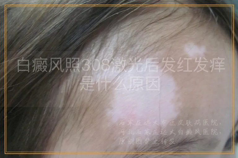 白癜风照308激光后发红发痒是什么原因