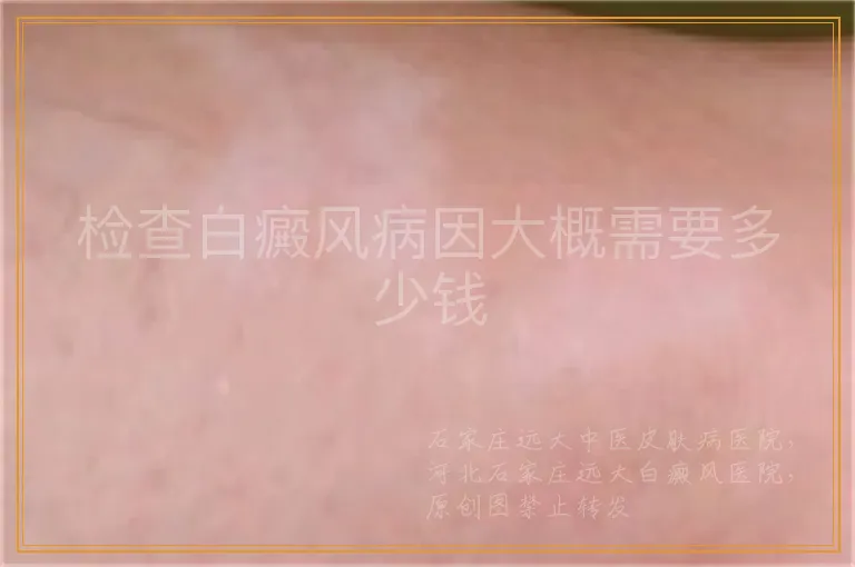 检查白癜风病因大概需要多少钱