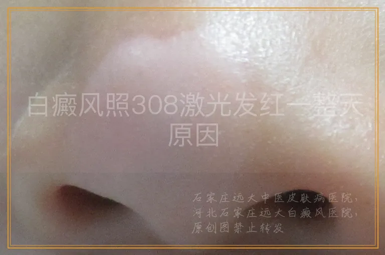 白癜风照308激光发红一整天原因