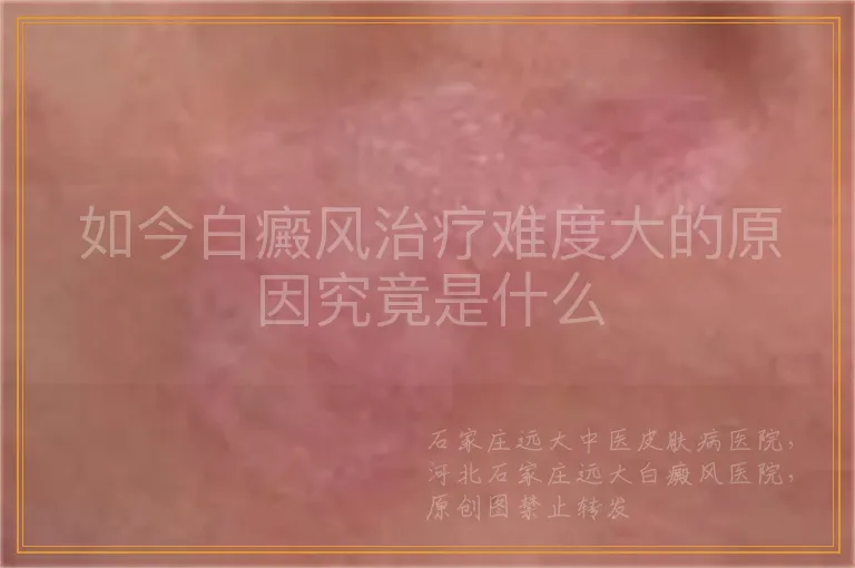 如今白癜风治疗难度大的原因究竟是什么