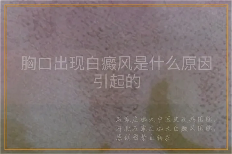 胸口出现白癜风是什么原因引起的