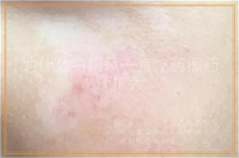 为什么白癜风一直吃药擦药还扩大