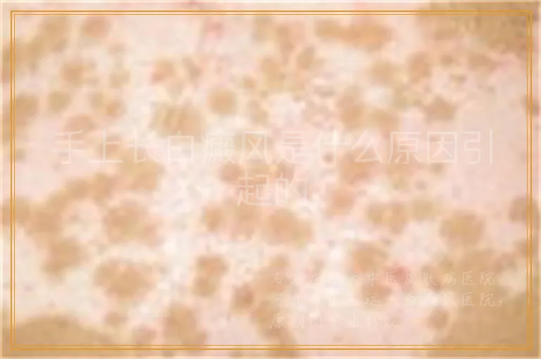 手上长白癜风是什么原因引起的