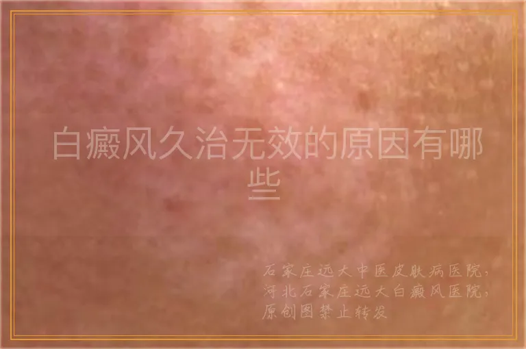 白癜风久治无效的原因有哪些