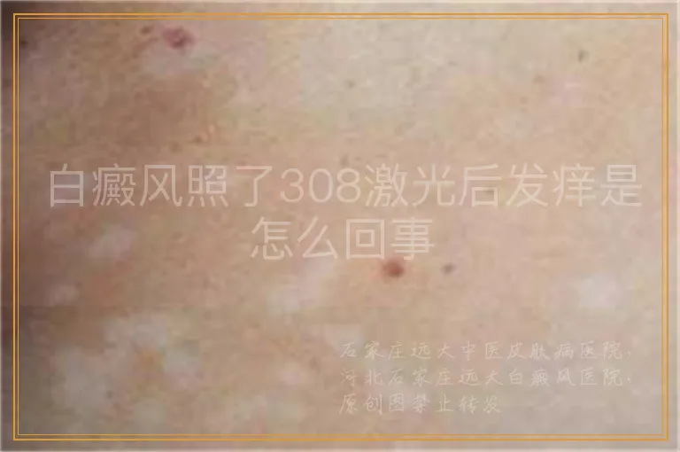 白癜风照了308激光后发痒是怎么回事