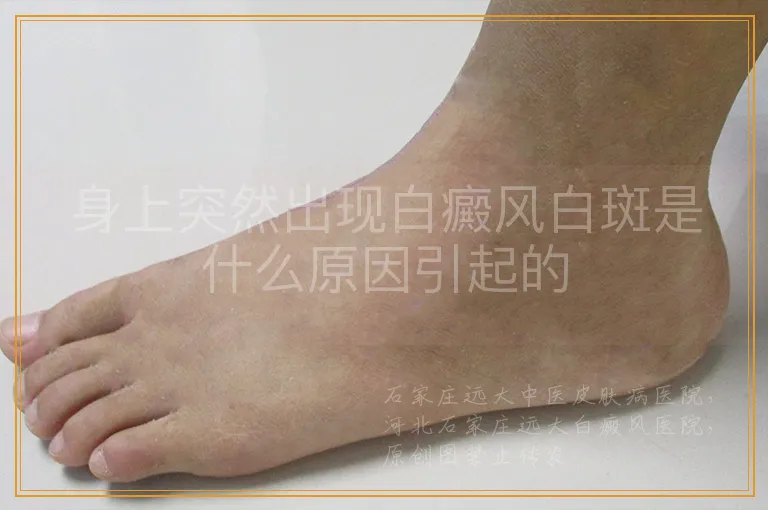 身上突然出现白癜风白斑是什么原因引起的