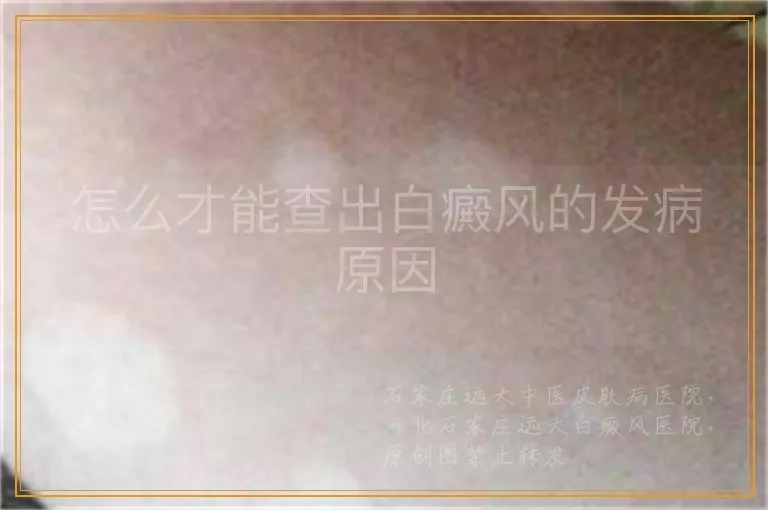 怎么才能查出白癜风的发病原因