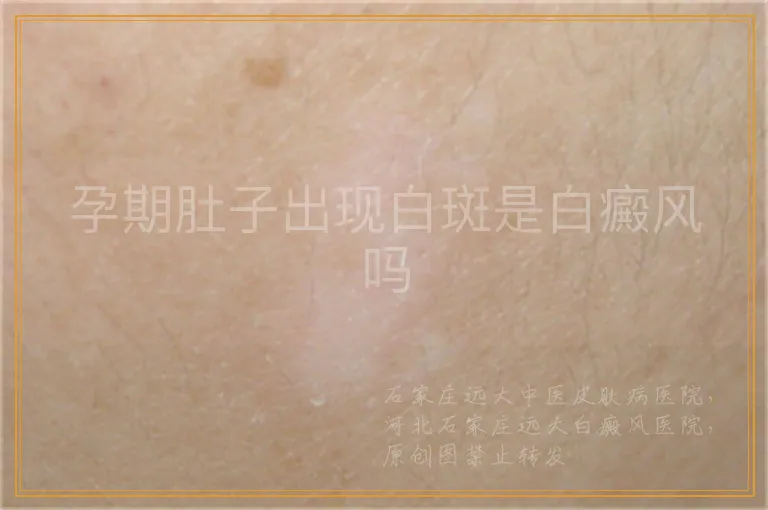 孕期肚子出现白斑是白癜风吗