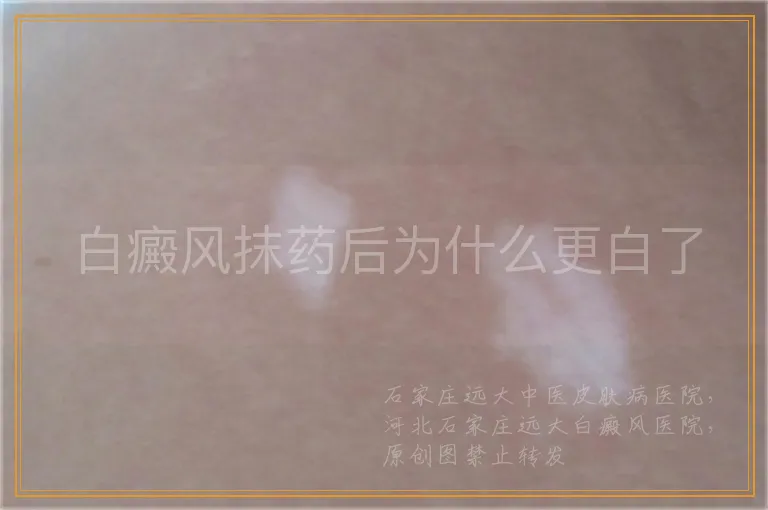 白癜风抹药后为什么更白了