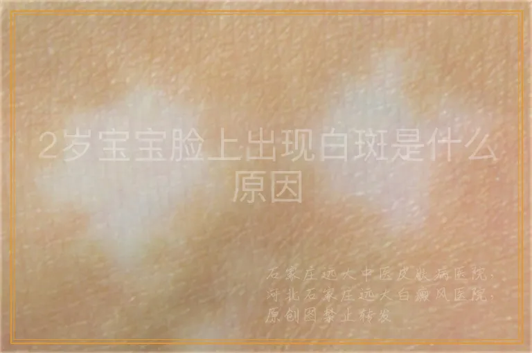 2岁宝宝脸上出现白斑是什么原因