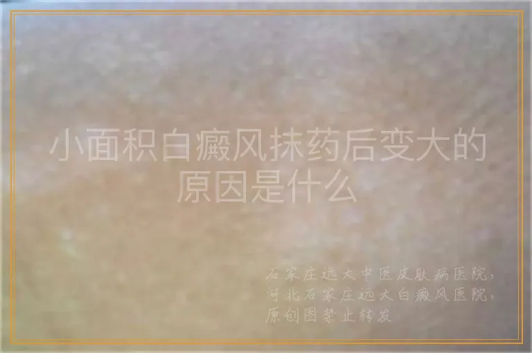 小面积白癜风抹药后变大的原因是什么