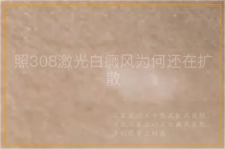 照308激光白癜风为何还在扩散