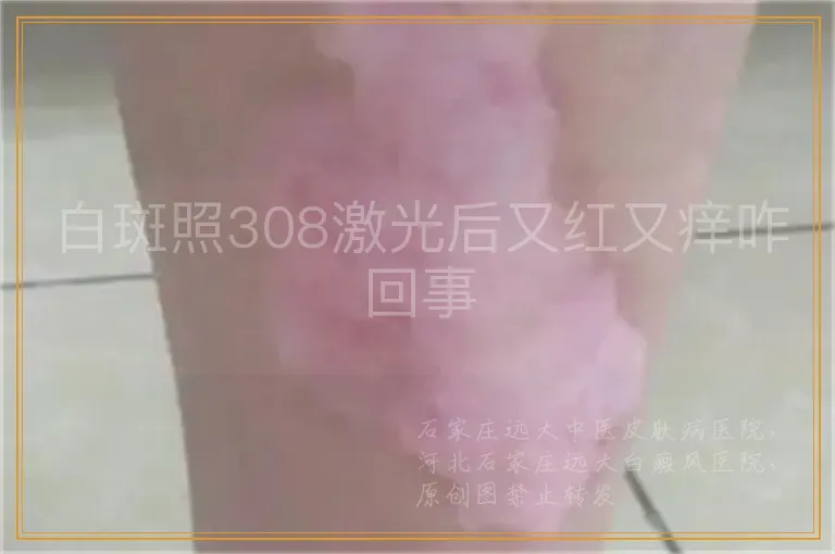 白斑照308激光后又红又痒咋回事