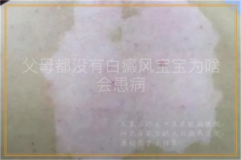 父母都没有白癜风宝宝为啥会患病