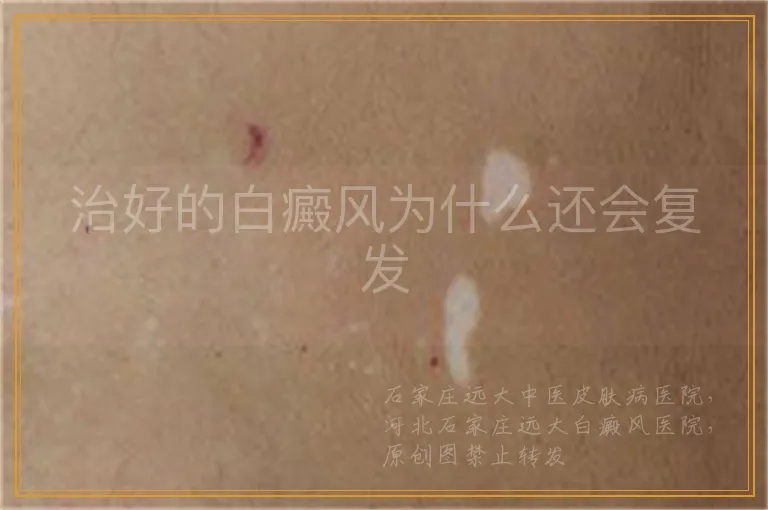治好的白癜风为什么还会复发