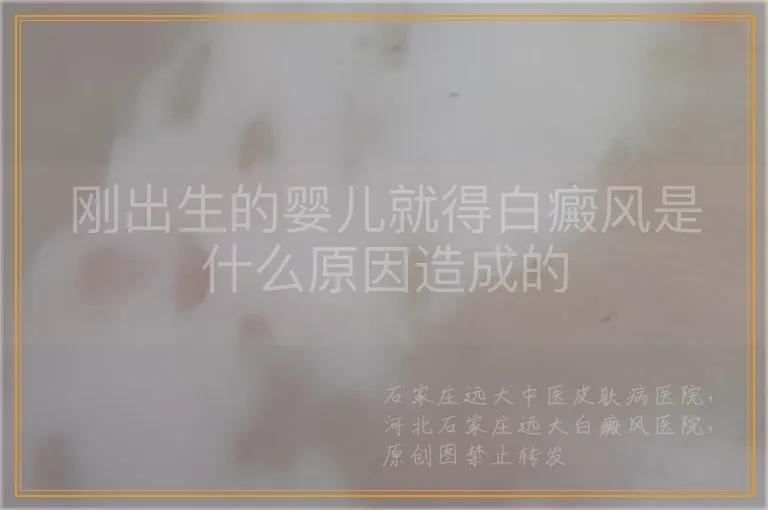 刚出生的婴儿就得白癜风是什么原因造成的