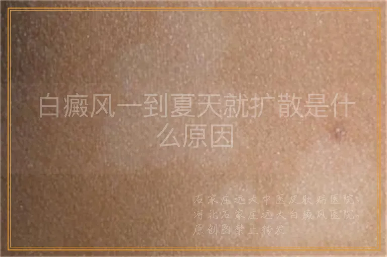 白癜风一到夏天就扩散是什么原因