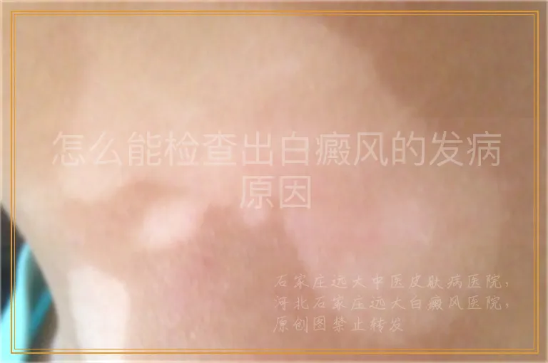 怎么能检查出白癜风的发病原因