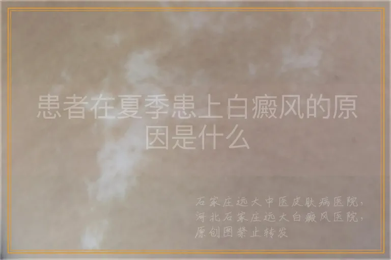 患者在夏季患上白癜风的原因是什么