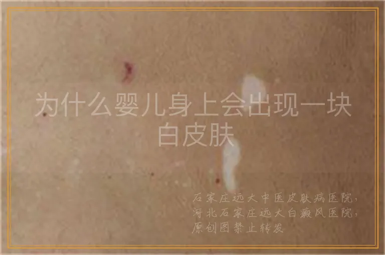 为什么婴儿身上会出现一块白皮肤