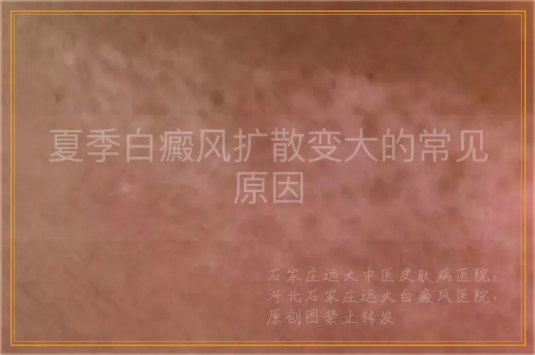 夏季白癜风扩散变大的常见原因