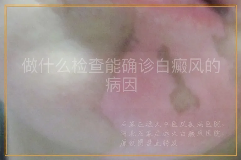 做什么检查能确诊白癜风的病因