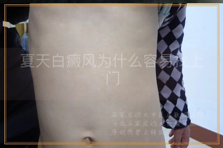 夏天白癜风为什么容易找上门