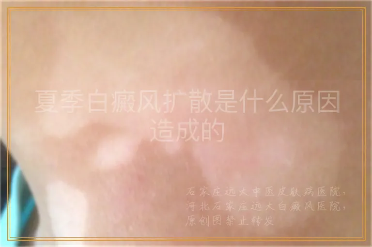 夏季白癜风扩散是什么原因造成的