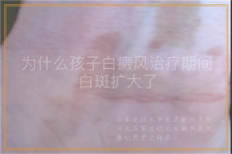 为什么孩子白癜风治疗期间白斑扩大了