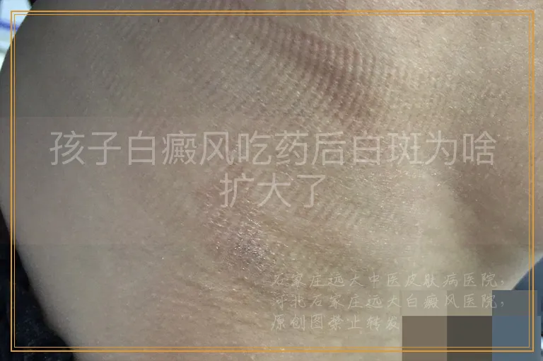 孩子白癜风吃药后白斑为啥扩大了
