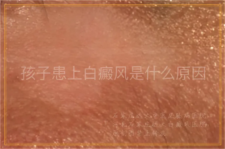 孩子患上白癜风是什么原因