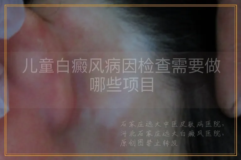 儿童白癜风病因检查需要做哪些项目
