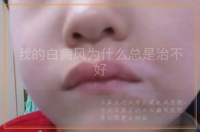 我的白癜风为什么总是治不好