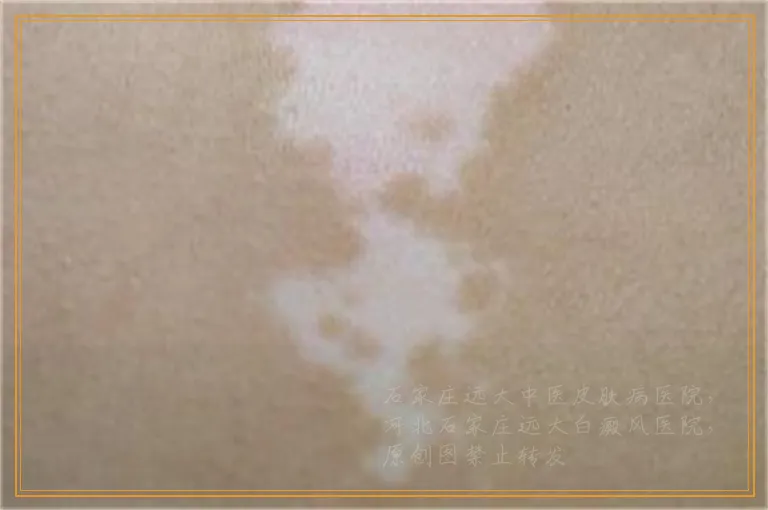 是不是极速308治白癜风好的比较快